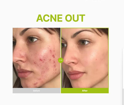Purito Azelaic Acid 10 Kojic Tea Tree Serum 30ml