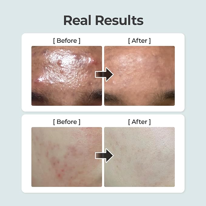 Numbuzin No.1 Pure-Full Calming Herb Toner - Toner for Acne-Prone and Sensitive Skin - Clears Acne, Soothes Irritation