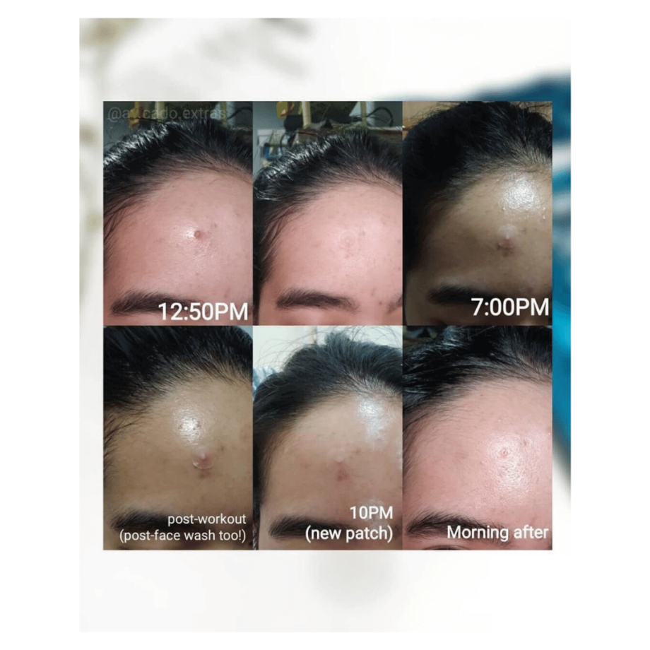 Before and After of By Wishtrend Clear Skin Shield Patch Media 1