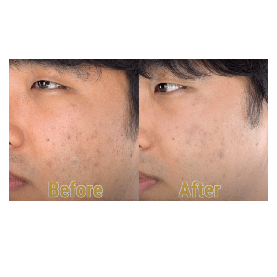 Before and After of By Wishtrend Polyphenols in Propolis 15% Media 1