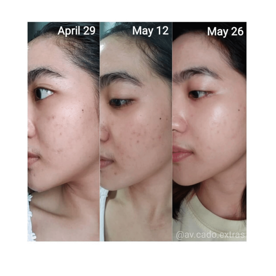 Before and After of By Wishtrend Quad Active Boosting Essence Media 2