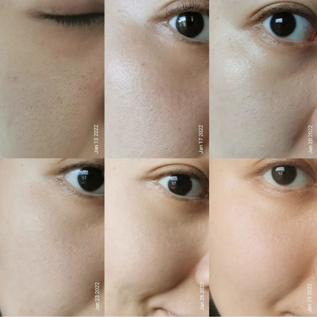Before-and-after using the BWT Vitamin A-mazing Bakuchiol Night Cream
